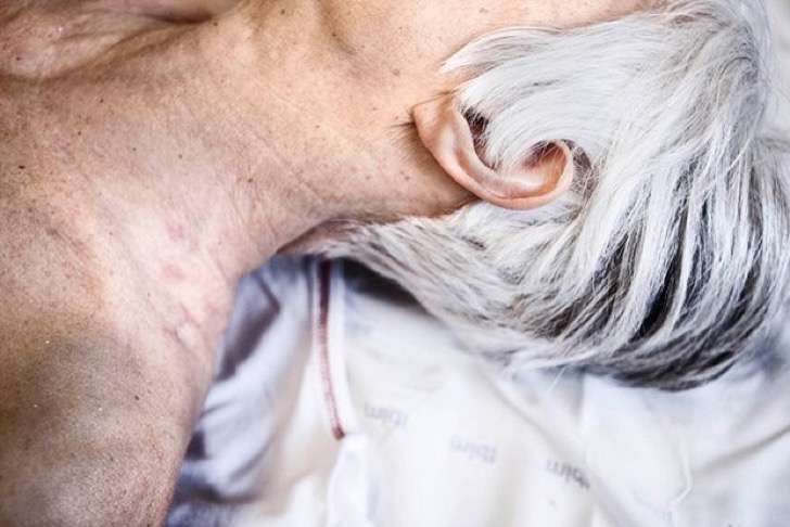 El aceite de la bardana de la alopecia