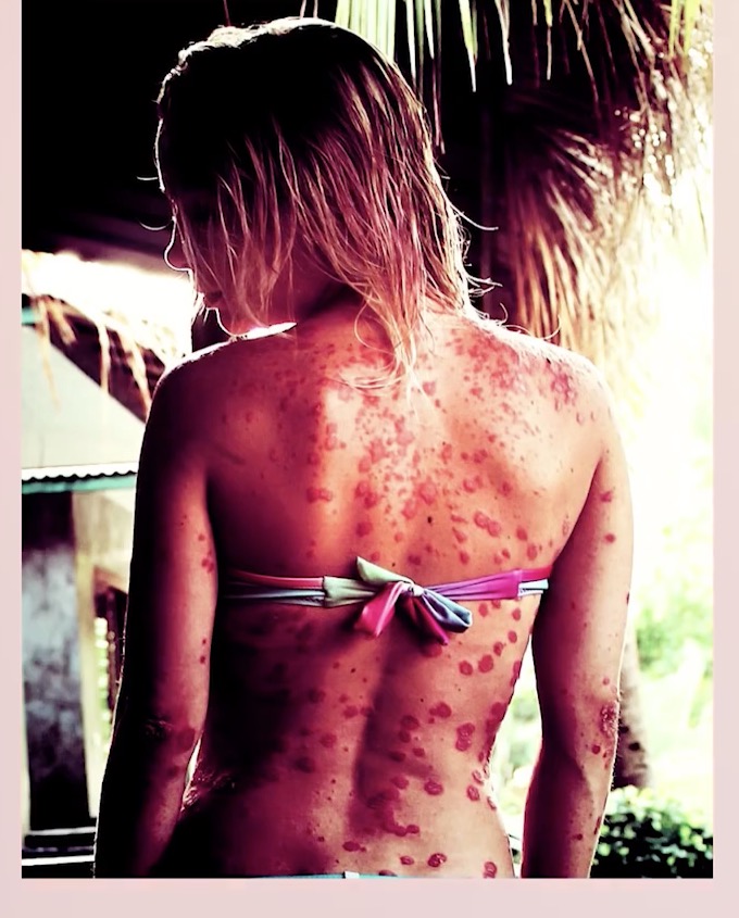 Blyashkovidnyy la psoriasis a los niños de la foto