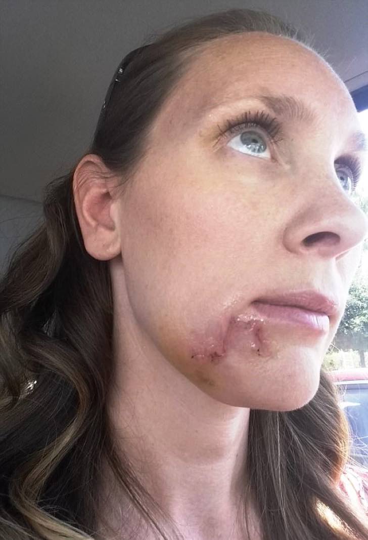 No cuidó la “espinilla” que apareció en su rostro. Semanas