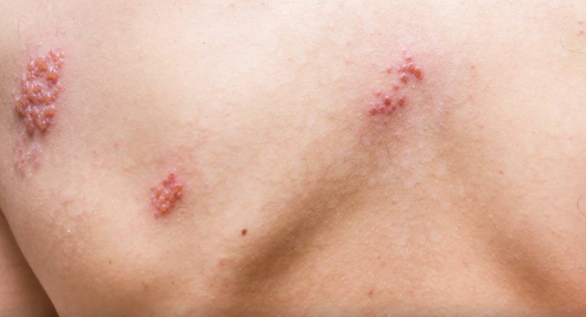 Herpes Zoster Puede Volver A Salir