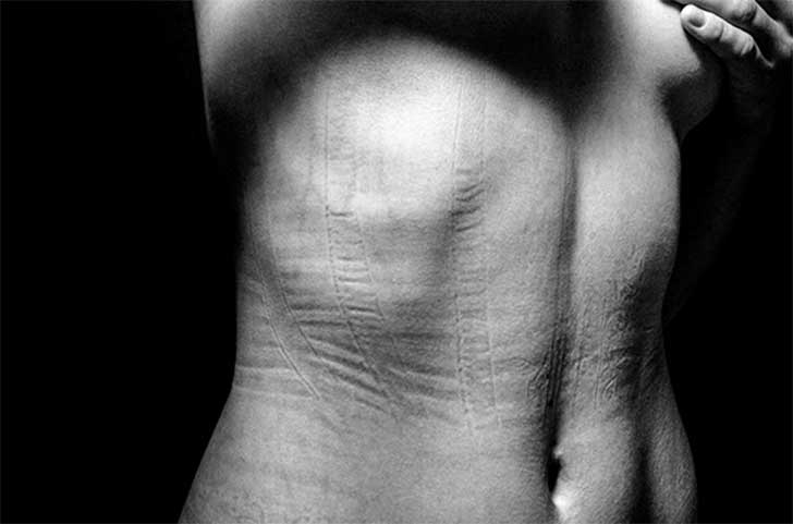 Marcas en la piel por presion